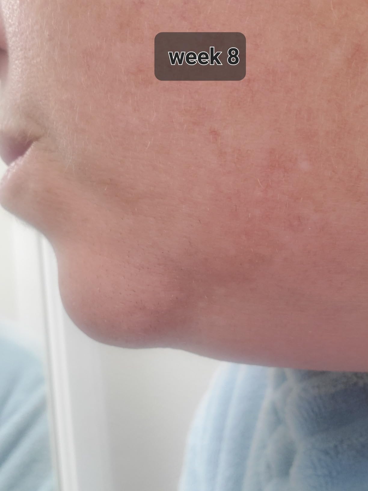 SmoothSkin Pure Fit IPL Hair Removal Device - At-Home Laser Hair Removal for Women & Men, Visible Results in 2 Weeks, Includes Precision Head, Safe for Face & Body, Long-Lasting Hair Reduction customer photo 1