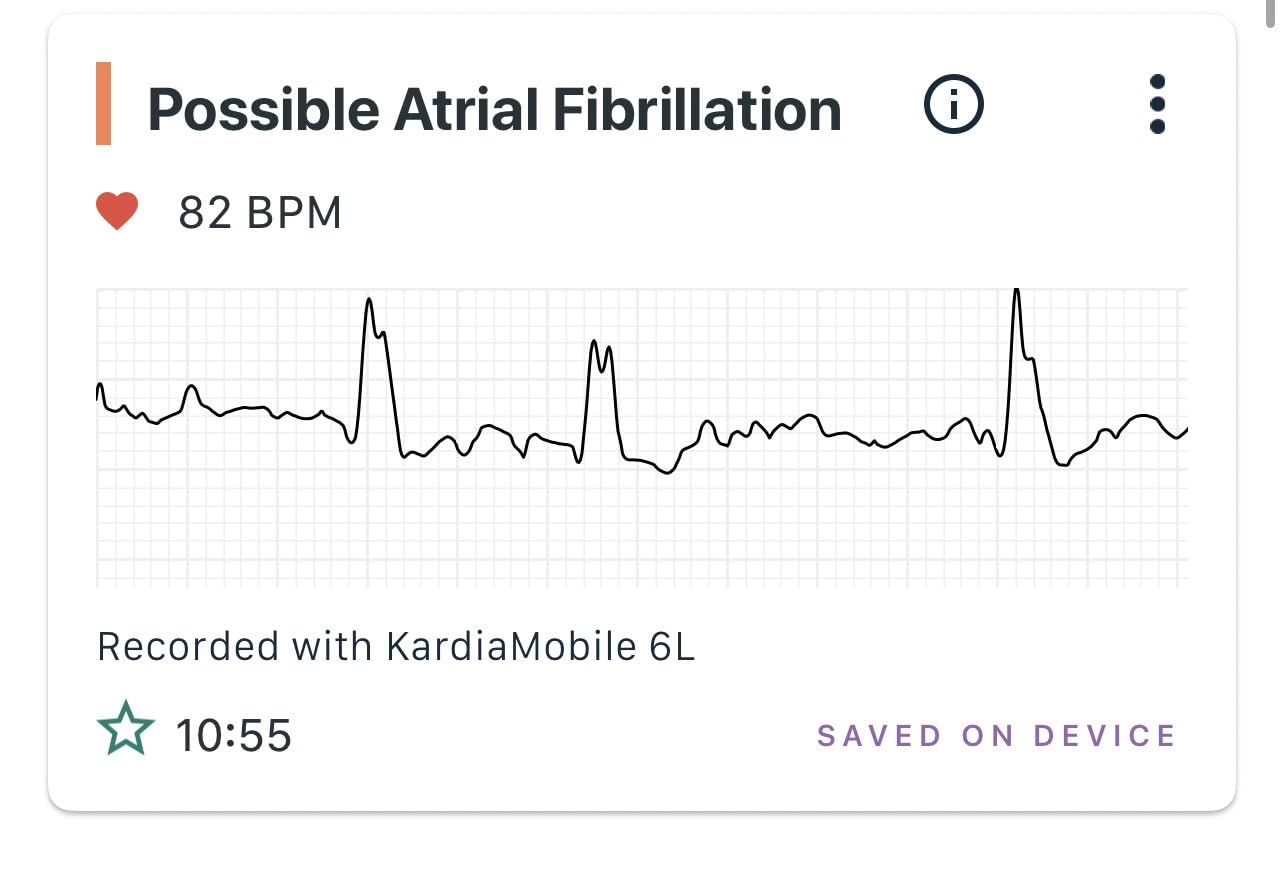 KardiaMobile 6-Lead Personal EKG Monitor - Six Views of The Heart - Detects AFib and Irregular Arrhythmias - Instant Results in 30 Seconds - Works with Most Smartphones - FSA/HSA Eligible customer photo 1